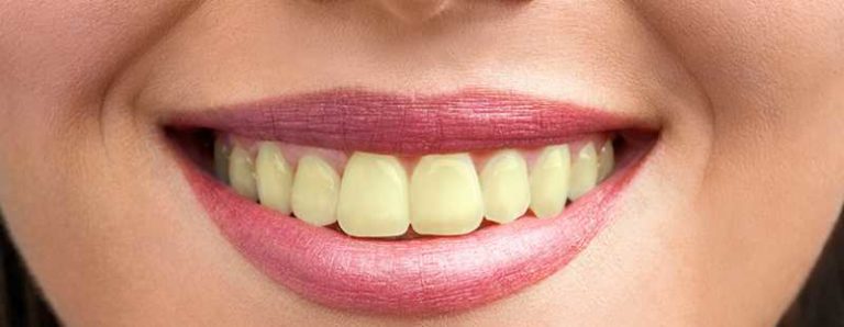 Por que os dentes amarelam e como evitar isso