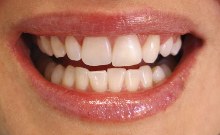 Descubra os problemas que dentes tortos e mal posicionados podem causar