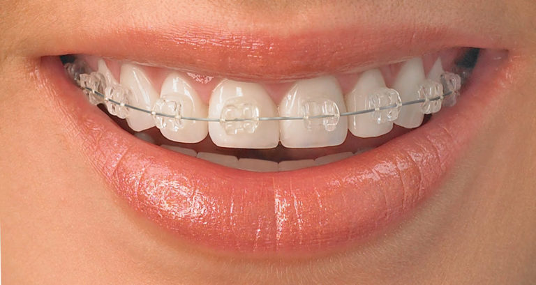 Aparelho fixo pode deixar os dentes manchados ou moles?