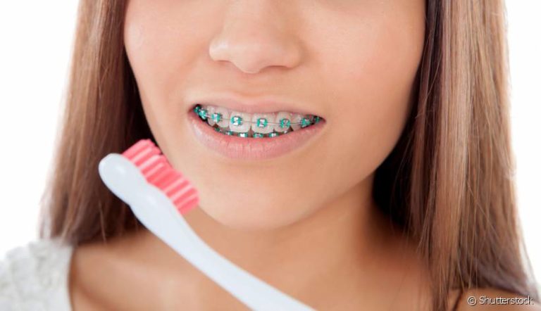 5 cuidados para se ter com seu aparelho dentário