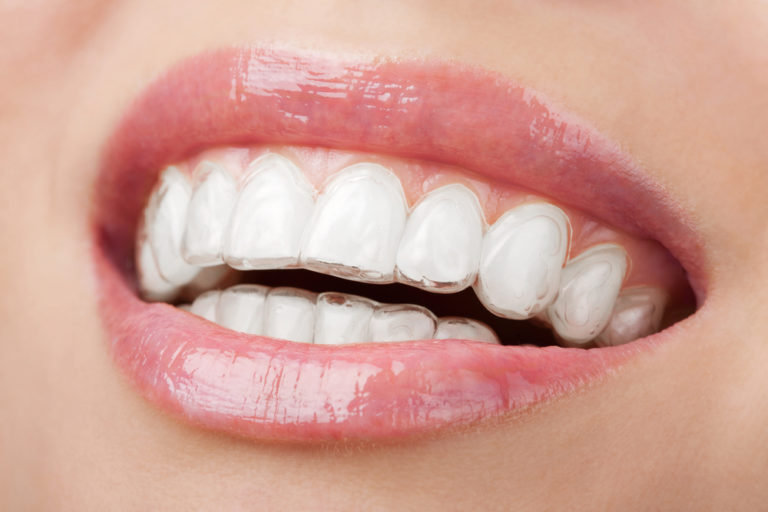 Dentes tortos podem causar mau hálito: aprenda a prevenir