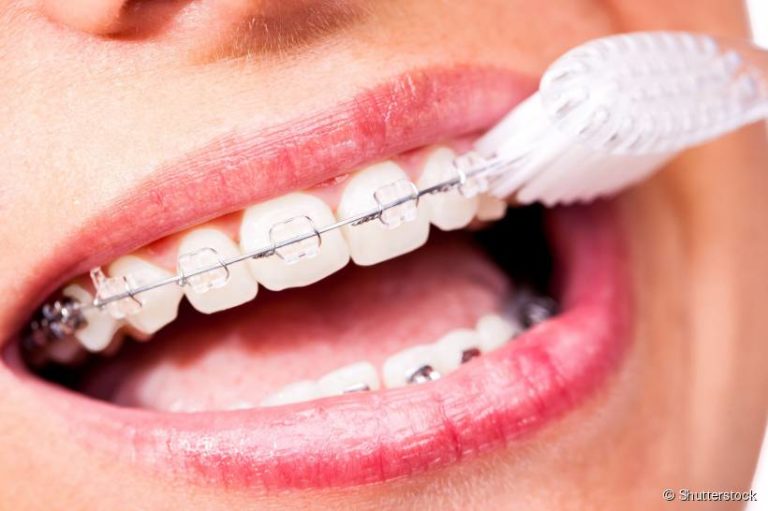 Como Fazer a Limpeza dos Dentes com Aparelho Ortodôntico