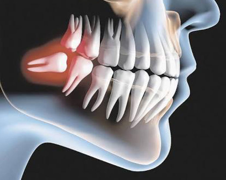 Especialista destaca dicas para cuidar do dente do siso