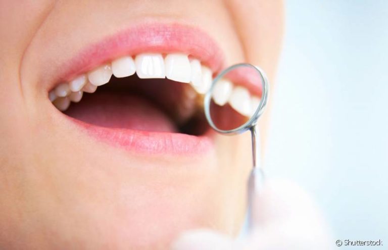 Gengivite pode levar a perda de dentes e comprometer a saúde geral do organismo