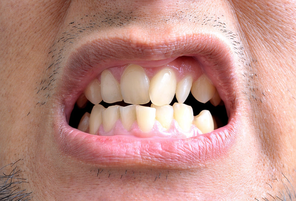 5 Fatores Que Podem Entortar Os Dentes SHZ Odontologia 