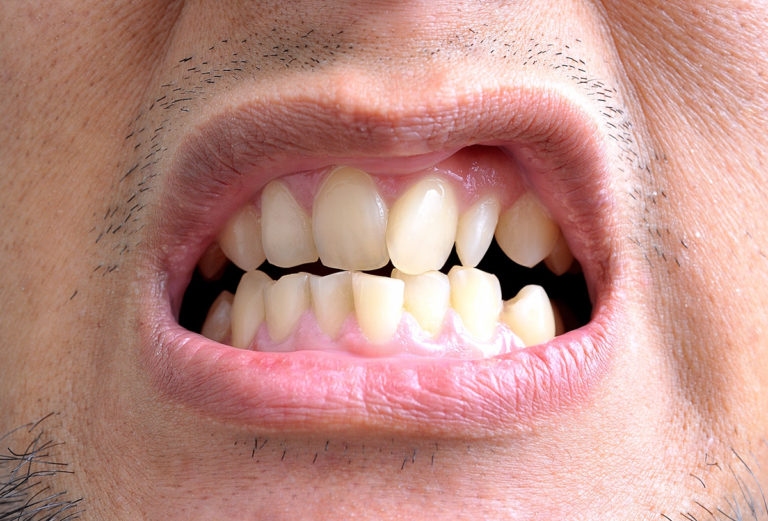 5 Fatores que Podem Entortar os Dentes