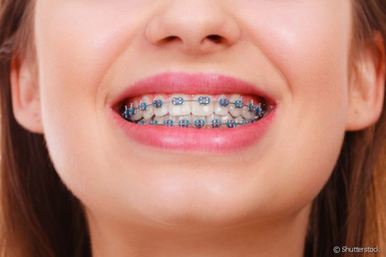 Dicas que ajudarão a cuidar dos dentes com aparelho