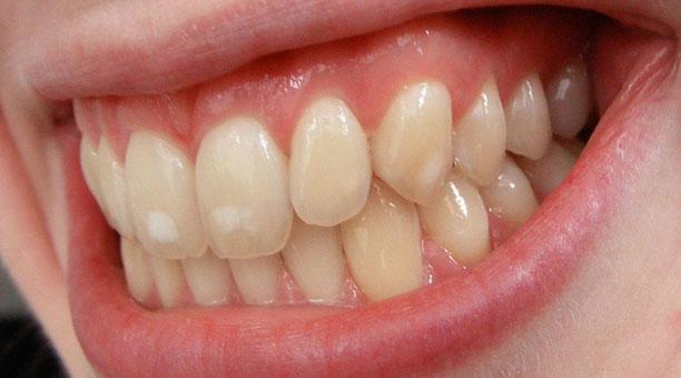 O que pode ser dente escurecido e como é feito o tratamento