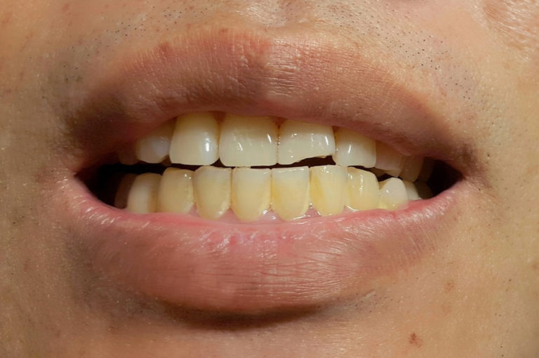 Tártaro nos dentes: o que é, causas e como tirar