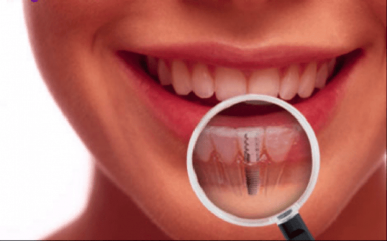 Implantes dentários: tudo o que você precisa saber sobre a substituição de dentes perdidos