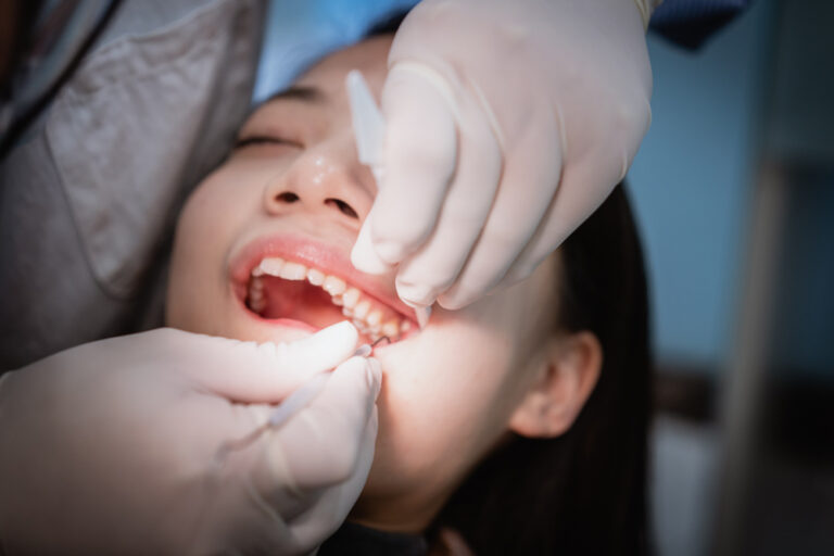 Preciso remover meus dentes de siso?