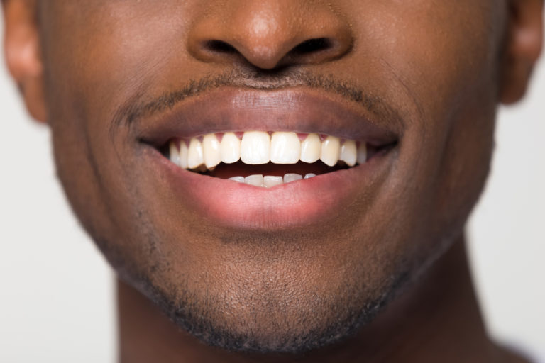 Clareamento dental: Técnicas disponíveis e cuidados necessários para manter o sorriso branco