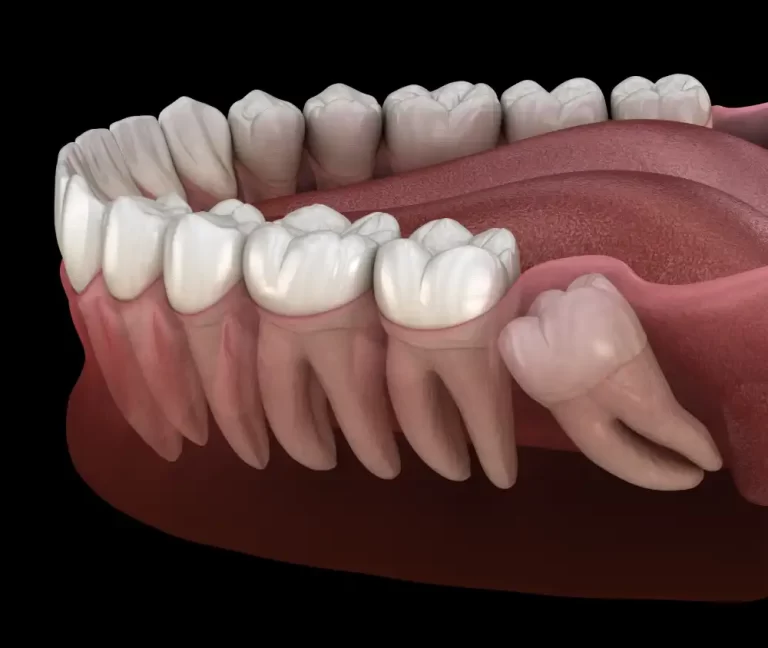 Siso: por que você não deve atrasar a cirurgia de retirada?