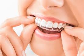 Invisalign®: Como funciona e quais são os benefícios desse alinhador ortodôntico?